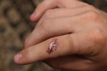 Stitches, sutures, on index finger to close cut, wound. Heal, less scarring and prevent infection. Injury, medical, doctor, hospital, emergency and urgent care. Cricket ball jamming finger against bat