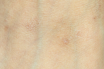 Skin peeling from dry air? Easily restore with deep nourishment