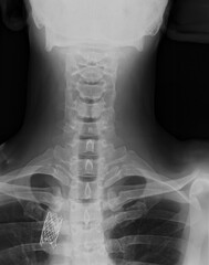 Cervical Spine X-ray with Aorta Stent in Chest 