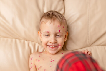 Child with visible chickenpox rash sitting on sofa during daytime in a well-lit room