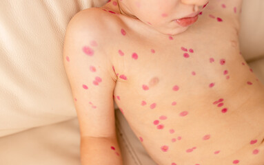 Child with visible chickenpox rash sitting on sofa during daytime in a well-lit room