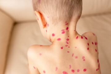 Chicken pox (varicella). Contagious disease. Sick child with chickenpox. Varicella virus or...