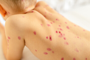 Child with red spots on the back in a medical setting highlighting health condition and care