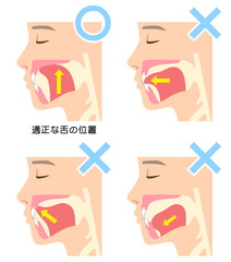 正しいミューイングの方法　適正な舌の位置と誤った舌の位置 © koti
