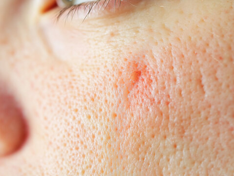Close-up of irritated skin with mosquito bite mark.