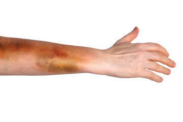 Large Bruise On Woman Arm Domestic Violence