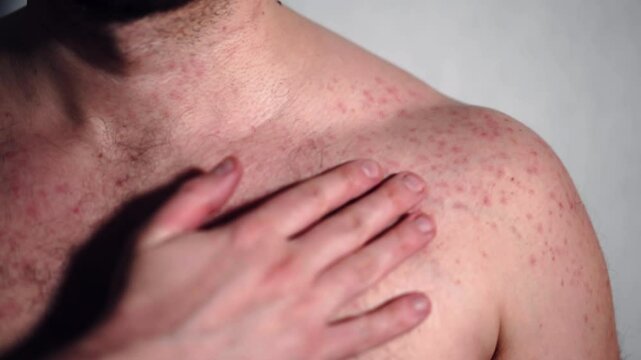 Strong skin rushes because of allergy reaction, infected insect bite, food or chemicals poisoning, man hand touching small red pimples on his shoulder and chest, itchy skin acne and epidermis problem