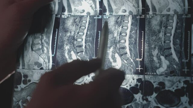 Doctor Points at Spine MRI Scan on Medical Viewbox, Showing Lumbar Problems in Hospital, Close Up Shot