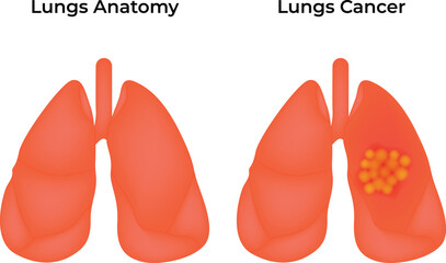 Fototapeta premium Healthy Lungs and Cancer Lungs Anatomy Science Design Vector Illustration Diagram