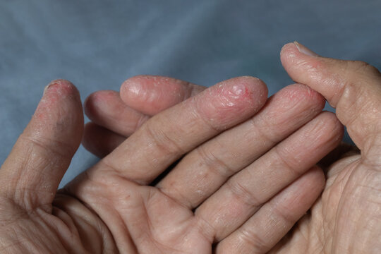 Fingers of a patient with atopic dermatitis after prolonged exposure to alkaline chemicals. Inflamed skin for health care and medical background.
