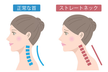 ストレートネックの女性　ビフォアアフター