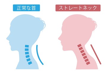 ストレートネックの女性　シルエット　ビフォアアフター
