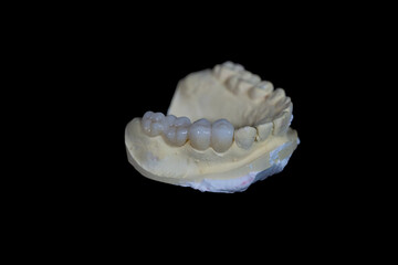 Upper jaw tooth model made of yellow dental stone. In the left region, there are premolar and molar...
