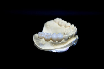 Upper jaw tooth model made of yellow dental stone. In the left region, there are premolar and molar zirconia dentures. © Johanes