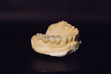 Upper jaw tooth model made of yellow dental stone. In the left region, there are premolar and molar zirconia dentures. © Johanes