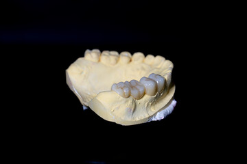 Upper jaw tooth model made of yellow dental stone. In the left region, there are premolar and molar zirconia dentures. © Johanes