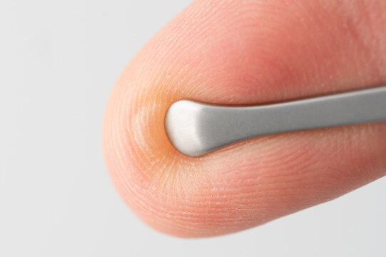 Close up of pinching blister