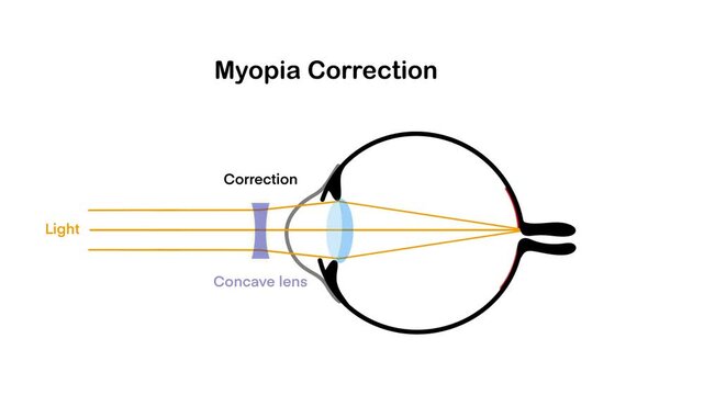 illustration of biology and physics, Diagram of myopia correction showing how a concave lens adjusts light rays to focus properly on the retina, explaining nearsightedness treatment