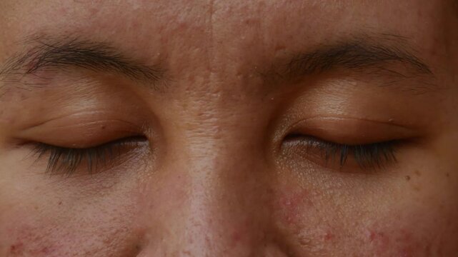 Close-up of a woman's face highlighting her eyes and problematic skin condition. An Asian woman's facial skin is experiencing issues (acne scars).