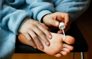 Close-up of hands of a Caucasian school-age boy applying warts and corns tincture on his big toe at home. Treatment of calluses, pressure corns and plantar warts. Dermatological problems of feet