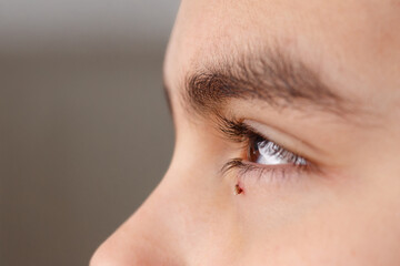 Close-up of human eye with wart on lower eyelid, after nitrogen treatment. Falling off, skin changes, for dermatology and skin health concept. Suitable for medical articles, pharmaceutical companies,