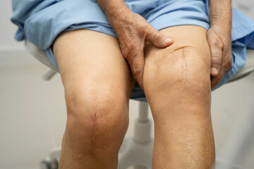 Asian elderly woman patient with scar knee replacement surgery in hospital.