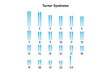 Turner Syndrome Science Design. Vector Illustration.