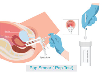 Pap Smear Cervical Cancer Screening.