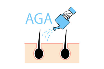 AGA治療のイメージイラスト―毛髪にじょうろで育毛剤を与える人物の手元