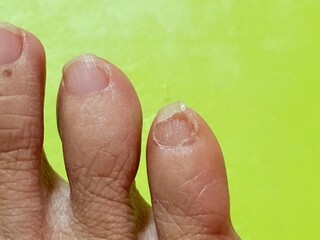 A toenail that is about to fall off.