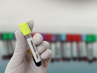 Scientist hold blood sample test tube for  Adiponectin-test with laboratory background. Healthcare...