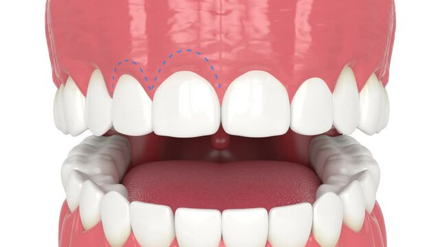 Human jaw treated with laser for gummy smile. Creating a new gum line by gingivectomy.