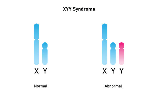 XYY Syndrome Science Design. Vector Illustration.