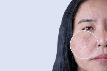 Enlarged circles indicate facial skin problems such as blemishes, freckles, uneven skin tone and large pores on combination skin. Dull and rough skin. The concept of good health	