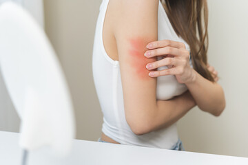 Dermatology asian young woman, girl allergy, allergic reaction from atopic, insect bites on her arm, hand in scratching itchy, itch red spot or rash of skin. Healthcare, treatment of beauty.