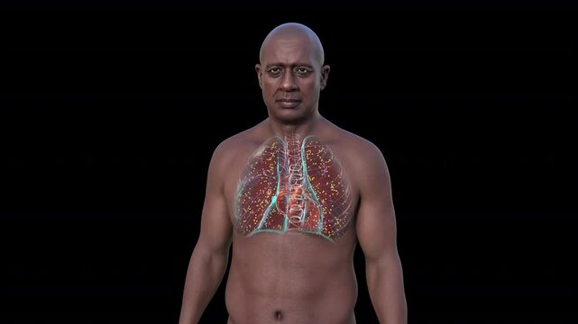 A man with lungs affected by miliary tuberculosis, a disseminated form of tuberculosis characterized by numerous tiny lesions scattered throughout the lungs, 3D animation.