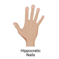 Fingernail clubbing or hippocratic nails on the hand.