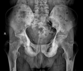 Pelvis AP X-ray for Pelvic fracture