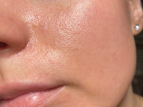 Macro photo of big pore on oily facial skin type. Skin with enlarged pores. Care for problem skin. Sun, natural light