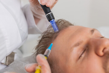 Alopecia. Man hair loss improve growth treatment regeneration, dermapen microneedling vitamin exosomes syringe injections. Trichologist cosmetologist doctor head scalp procedure fractional mesotherapy