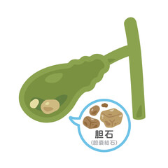 胆石ができた胆嚢のイラスト2