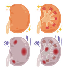 健康でキレイな腎臓と炎症が起きた不健康な腎臓のイラスト