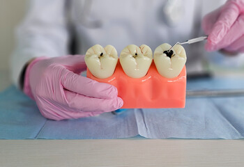 The doctor talks about dental caries and plaque, the process of demineralization, solutions to...