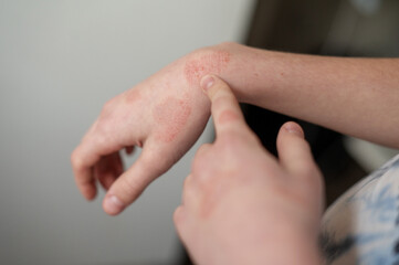 Cold dermatitis on a child's arm. How to treat peeling on your hands during the cold season....