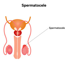 Spermatocele Testicular disease. Man reproductive health system pain testicle pathology problem. Medical diagram 