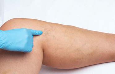 Removal of varicose veins on the legs. Medical inspection and treatment of Telangiectasia....