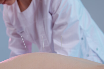 Close-up of a dry needling session where a practitioner inserts thin needles into a patient's back. Traditional Chinese medicine acupuncture to relieve pain and improve well-being.