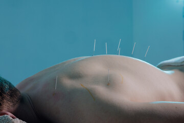 Close-up of a dry needling session where a practitioner inserts thin needles into a patient's back....