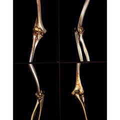 CT scan 3D image of an elbow joint showing dislocation and fracture after an accident female...