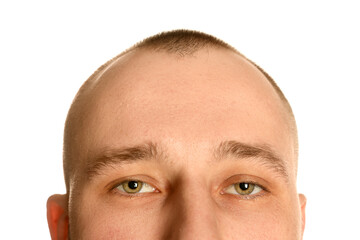 Baldness problem. Man with receding hairline on white background, closeup
